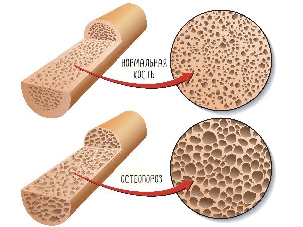 Белок и остеопороз