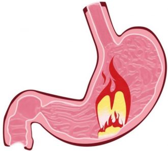 При язвенных гастритах прием молочной кислоты может быть опасен для здоровья